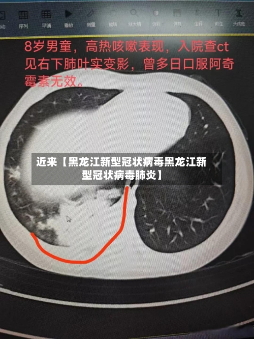 近来【黑龙江新型冠状病毒黑龙江新型冠状病毒肺炎】-第3张图片